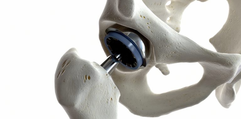 Determining When You Need A Hip Or Knee Joint Replacement