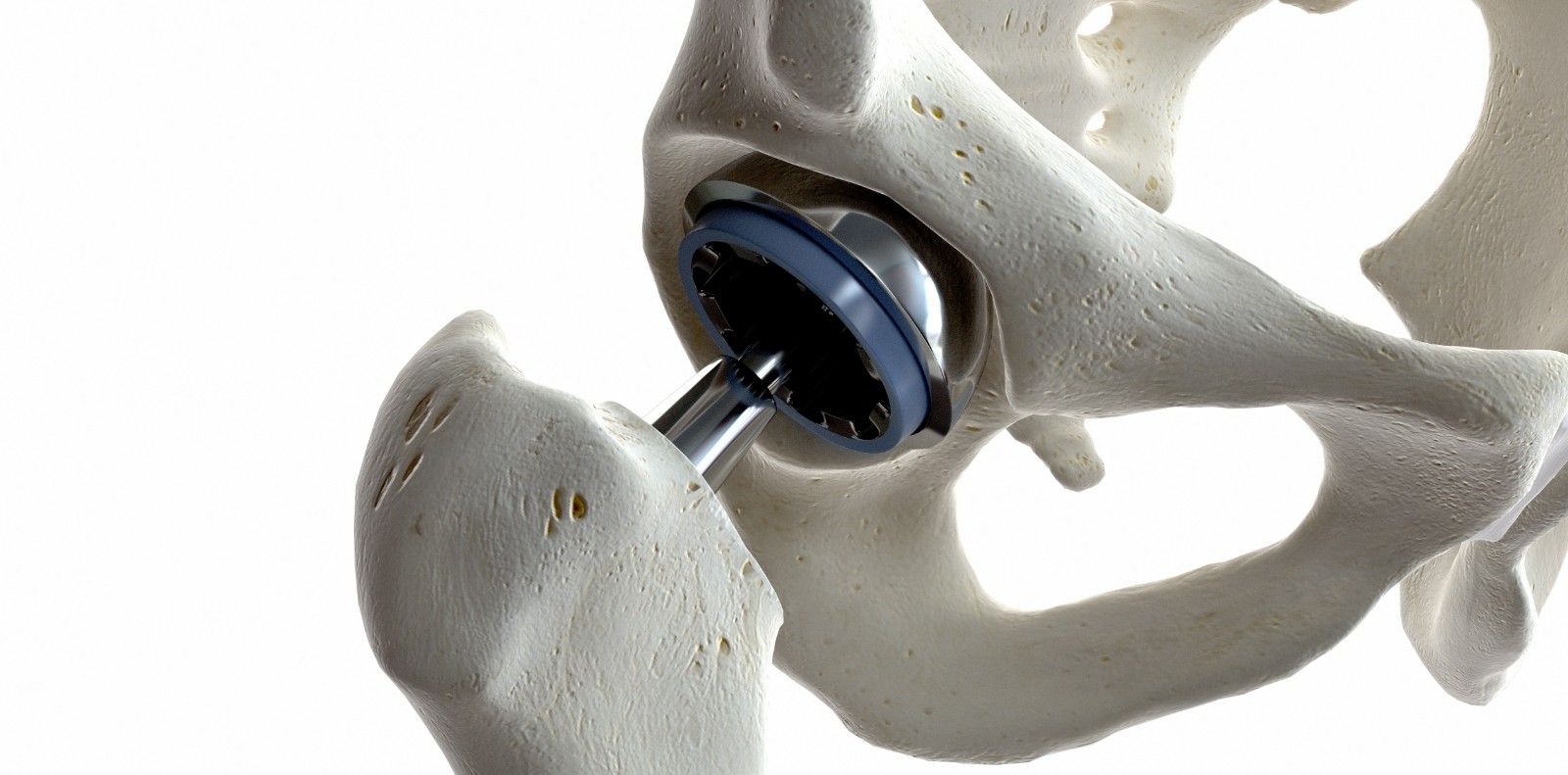 medically accurate illustration of a hip replacement