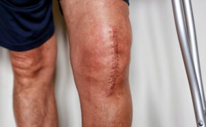 mans scarred knee after surgery