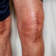 knee replacement scar