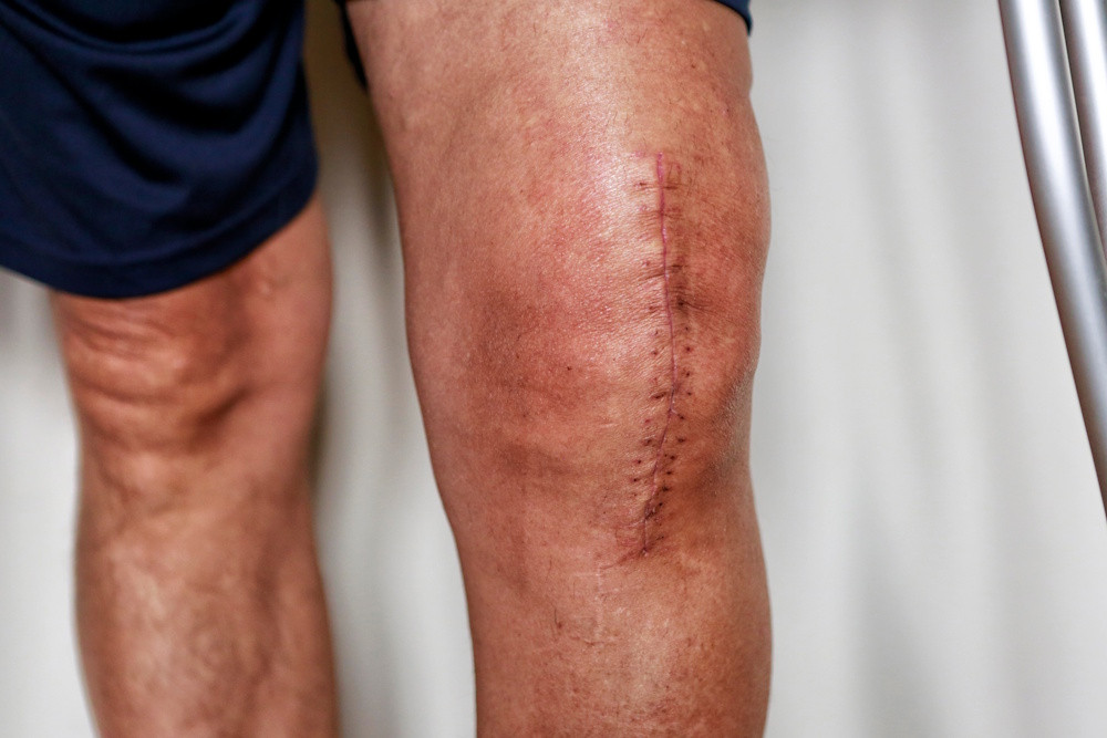 knee replacement scar